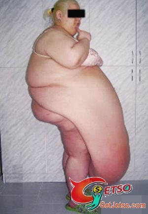 俄女子切除「超級肚腩」長近1米重57公斤圖片1