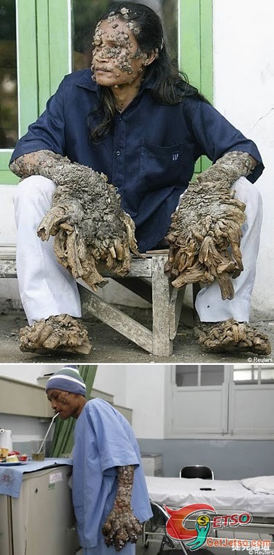 世界上7大最奇怪的皮膚病圖片6