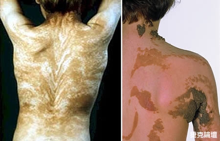 世界上7大最奇怪的皮膚病圖片4