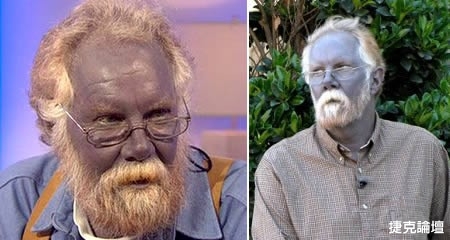 世界上7大最奇怪的皮膚病圖片7