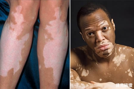 世界上7大最奇怪的皮膚病圖片5