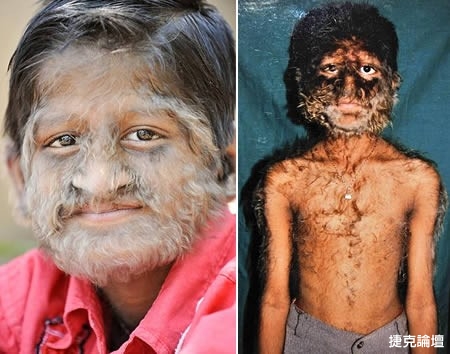 世界上7大最奇怪的皮膚病圖片3