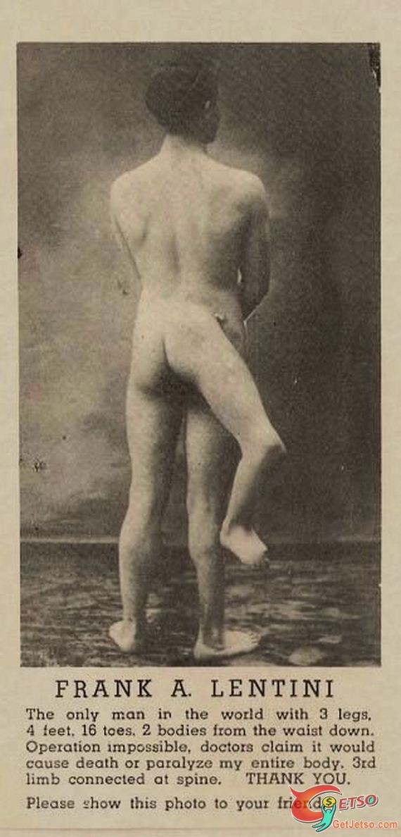 世界上唯一擁有三條腿的男人圖片1