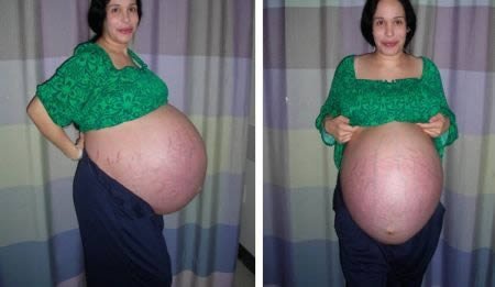 懷孕奇跡！墨西哥婦女身懷九胞胎圖片2