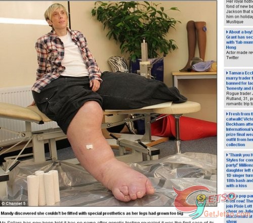 108公斤巨腿!英國38歲婦女雙腳長不停圖片1