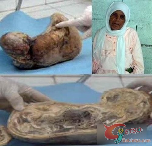 懷孕46年，八旬老婦腹中發現“化石胎”圖片1