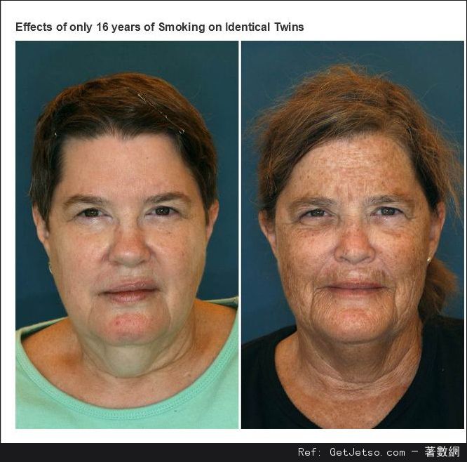 1對雙胞胎吸煙16年的比較圖片1