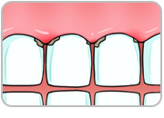 牙周病3階段圖片1