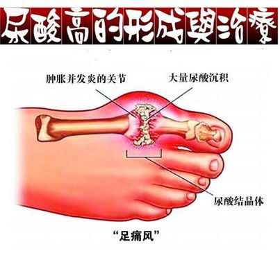 尿酸高的形成與治療圖片1