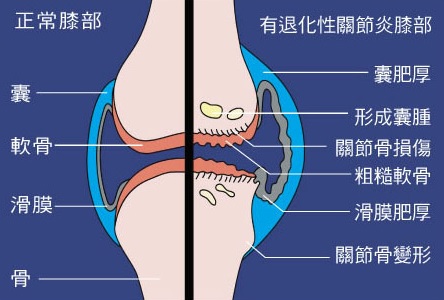 針灸中藥搭配，有效改善退化性關節炎圖片1