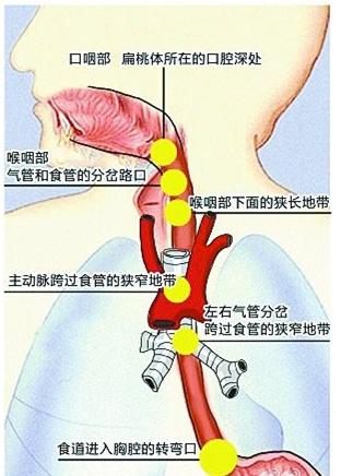 魚刺卡喉了，你真懂得怎麼做嗎？圖片5