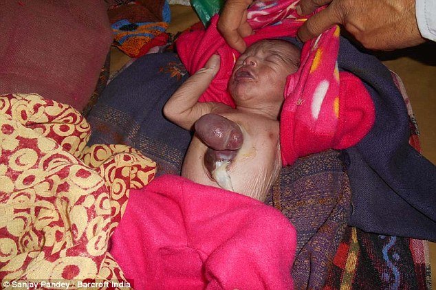 印度新生兒出生時心臟竟在體外，6天後仍活著屬奇蹟（膽小勿入）圖片1