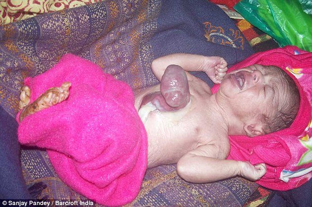 印度新生兒出生時心臟竟在體外，6天後仍活著屬奇蹟（膽小勿入）圖片3