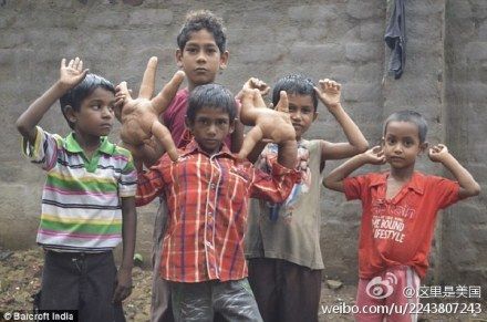 印度男孩手指粗如鋼管圖片4