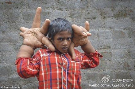印度男孩手指粗如鋼管圖片1