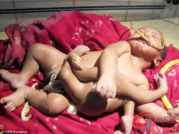 印度男嬰四手四腳，被認為梵天轉世圖片1