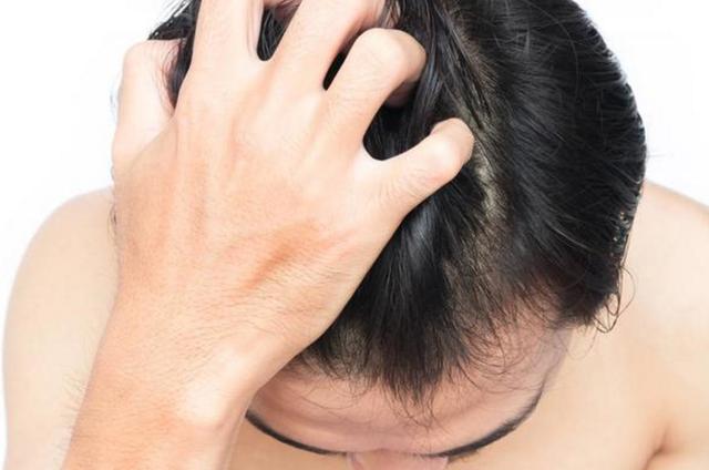 去除頭皮出油長痤瘡的方法圖片2